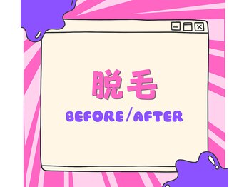 柏ベルミーランド/脱毛before→after