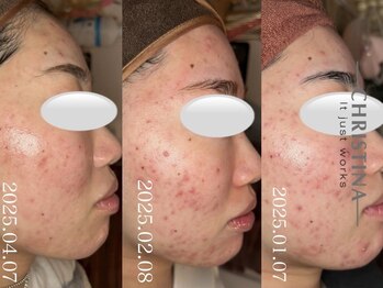 イデアル(Ideal)/超乾燥肌も使用可能◎¥9900～