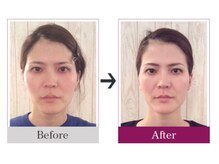 ビコツゼロ 青山(BIKOTSU ZERO)/小顔・エラ張り・顎の歪み