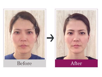 ビコツゼロ 青山(BIKOTSU ZERO)/小顔・エラ張り・顎の歪み