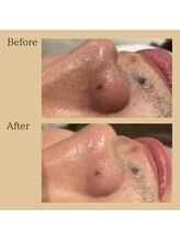 チャイディー(Chai Dee)/毛穴洗浄ハイドラ(1)