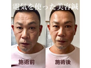 つばさ鍼灸院/男性も美容鍼!!