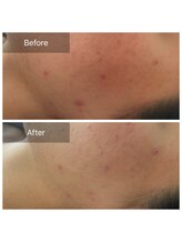 ルポアミ 代々木上原(REPOS AMI)/プラズマフェイシャル 1回の変化