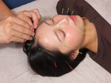 ココロ(CoCoLo)/美容鍼灸