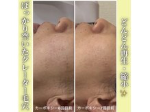 ハニエル(Haniel)/カーボキシー症例