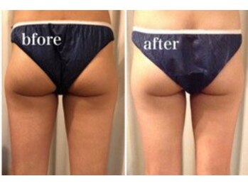 ルナ ボーテ(Lune Beaute)/下半身オーダーメイド3回痩身