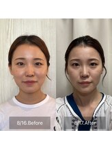 ハッピービューティーサロン じゆう(Happy Beauty Salon J∞YOU)/人気No.１魔法の小顔矯正/2回目