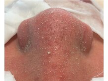 ヒスイ バイ アメイジング(Hisui by AMAZING)/【毛穴ケア】韓国式3D毛穴洗浄