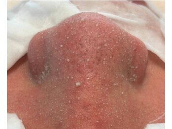 ヒスイ バイ アメイジング(Hisui by AMAZING)/【毛穴ケア】韓国式3D毛穴洗浄