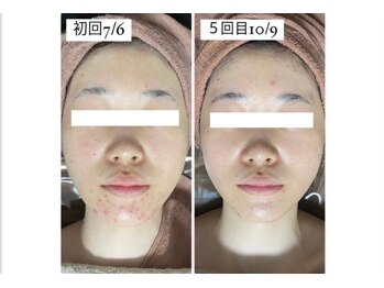 ホワイトアクア つくば店(WHITE AQUA)/ハーブピーリング/毛穴/研究学園