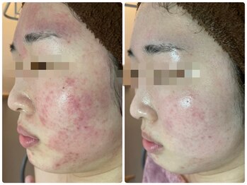 エヌエースキン センター北店(NA skin)/ハーブピーリング｜美白ケア