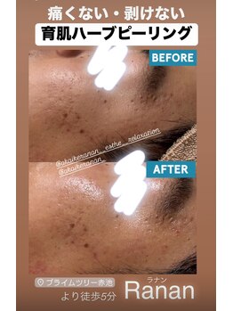 ラナン(Ranan)/ハーブピーリング