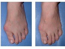 わたなべ接骨院/足の親指付け根の変形施術前後