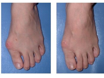 足の親指付け根の変形施術前後