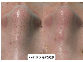 リメイク 銀座(REMAKE)/ハイドラ毛穴洗浄