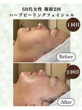 シーフェイス 横浜店(SEE FACE)/ハーブピーリングモニター2回目