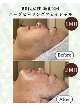 シーフェイス 横浜店(SEE FACE)/ハーブピーリングモニター2回目