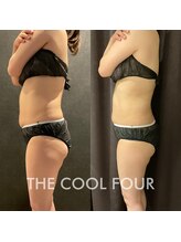 クライオ360(Cryo360)/脂肪冷却ビフォーアフター
