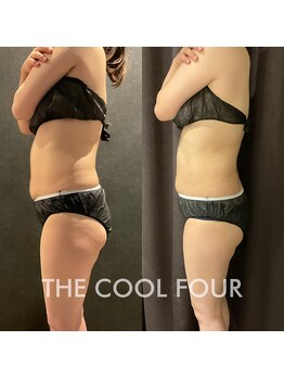 クライオ360(Cryo360)/脂肪冷却ビフォーアフター