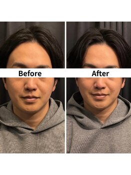 アロエベル(aloe Belle)/Before After（1回施術）