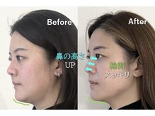 ラプリアンジュ 鹿児島天文館店(Raplit ange)/隆鼻＋輪郭矯正40分10回