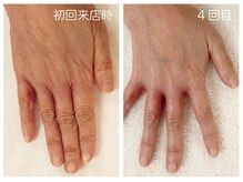 キレイテ 福岡天神店/50代/4回目【天神ハンドケア】