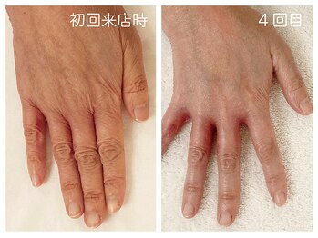 キレイテ 福岡天神店/50代/4回目【天神ハンドケア】