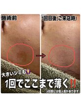 リズベット(LIZ BET)/大人気シミケア！３０分枠★