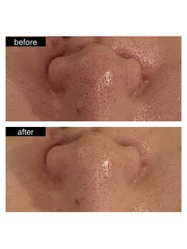 エスライン 円山店(Sline)/ニキビケアと一緒に