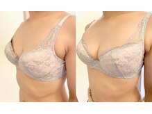 美人バスト アンド ヒップアップ 広島店/バストアップ症例写真