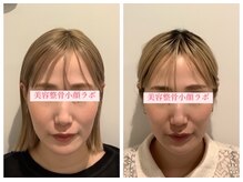 美容整骨小顔ラボ/小顔矯正ビフォーアフター