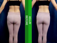 ジョワインフィニ 外苑前(JOIE INFINIE)/【ビフォーアフター】インディバ