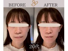 チョコバリ 渋谷店(chocobari)/小顔×リフトアップ(美容鍼)20代