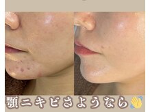 カッカ(kakka)/ハーブピーリング