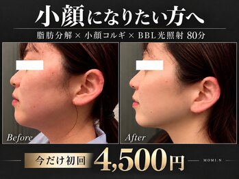 モミン(MOMI.N)の写真/【小顔になりたい方へ】脂肪分解×小顔コルギでフェイスラインすっきり♪むくみ・たるみも集中ケア