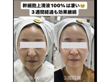 セリーニ(Selini)/ヒト幹細胞培養液フェイシャル