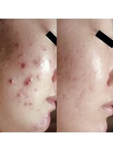 ホワイトアクア 梅田本店(WHITE AQUA)/ララピール/大阪/梅田/毛穴/小顔