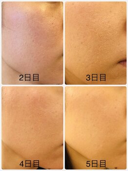 ベルミナ(BE.LMINA)/ハーブリプロ経過