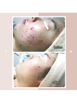 レゾン 京橋店/【ビフォーアフター】ニキビケア