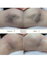 スプランドゥール(Splendeur)/レディース　脇　WAX＋光脱毛