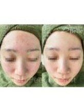 ベル 水戸(Belle)/ハーブピーリング|ニキビケア