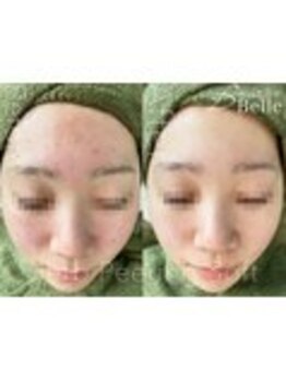 ベル 水戸(Belle)/ハーブピーリング|ニキビケア