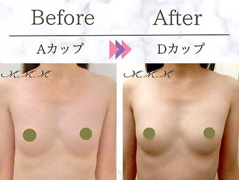 メディカルサロン エム エム エム 大阪梅田グランドサロン(M.M.M)/【バストアップ例】　A→Dカップ
