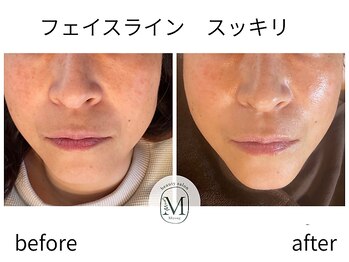 ミヨン(Miyong)/フェイスラインスッキリ★