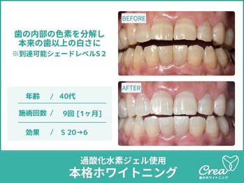 クレア(Crea)/【ホワイトニング症例写真】