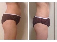 ルナ ボーテ(Lune Beaute)/お腹腰集中3回