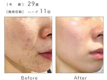 チップ(chip)/29歳／施術11回