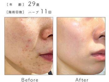 チップ(chip)/29歳/施術11回