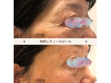ルル(LULU)の雰囲気（純粋レチノールピール）