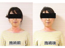 銀座スッキリ整体サロン/首肩肉スッキリで首長に！